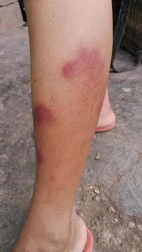 我妈妈腿上长了红斑,请问各位专家这是什么病情.