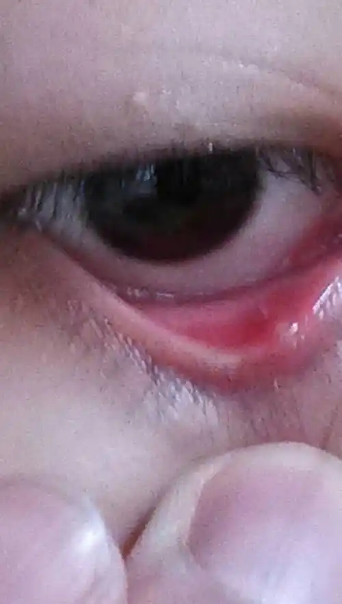 我眼睛里长了个痘痘样的东西,怎么办?