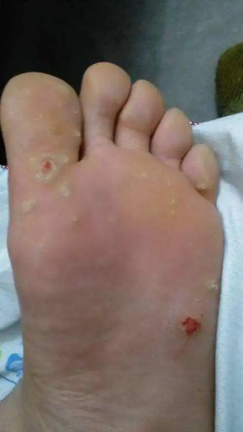 手心手指上长鸡眼初期图片