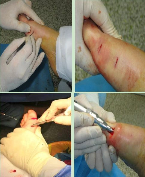 西安市中医医院踇外翻不仅仅是脚丑