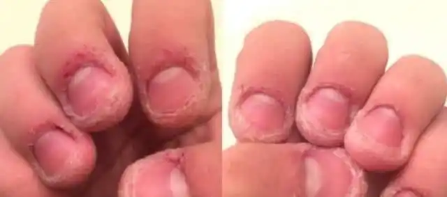 咬手指成瘾是强迫症,后果比你想的还严重!