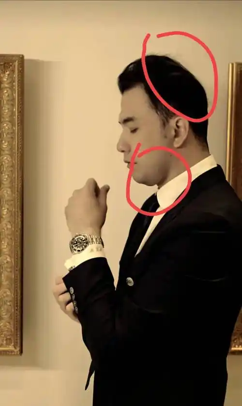 尤其一低头,双下巴和扁后脑勺更明显.下巴是怎么了?