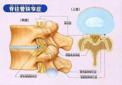 【康复&知识】腰椎管狭窄症的康复训练方案