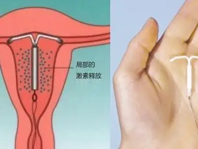 高清图解上环的全过程