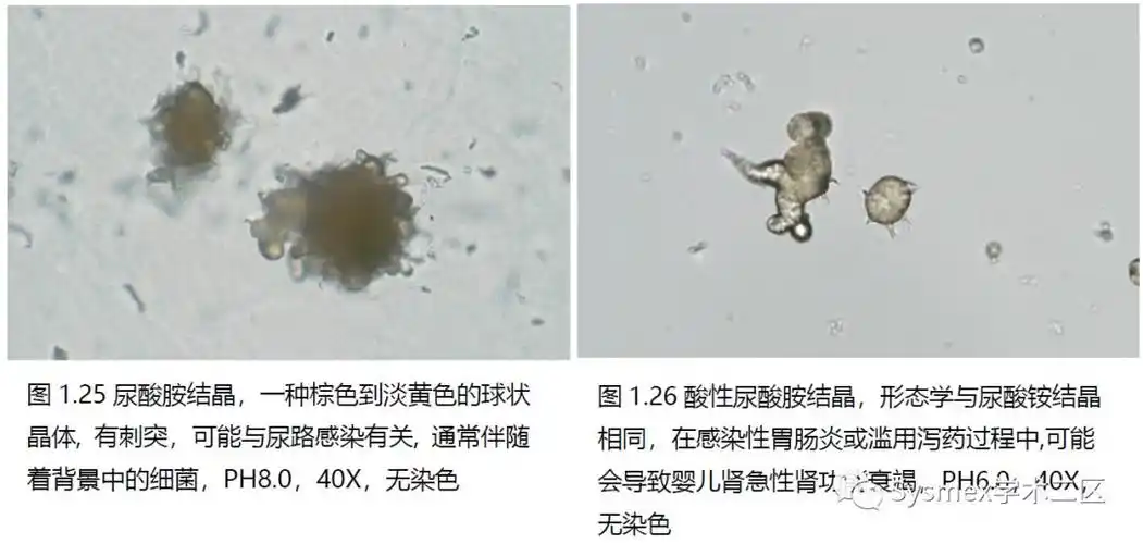 39种尿液结晶形态汇总