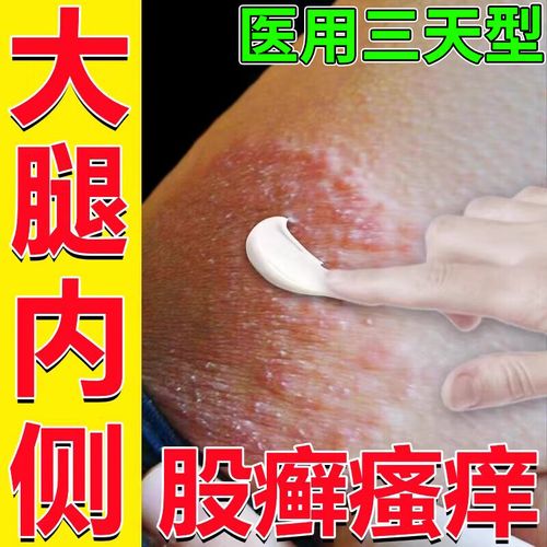 大腿根内测潮湿瘙痒 股癣专用药膏大腿内侧阴囊私处瘙痒 有小疙瘩皮炎