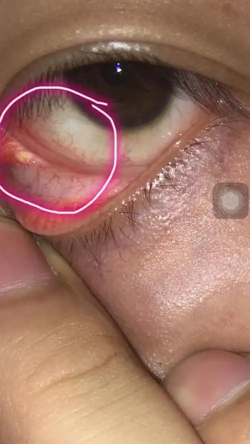 我的眼睛里面长了一个斑点白色的,是怎么回事,不疼