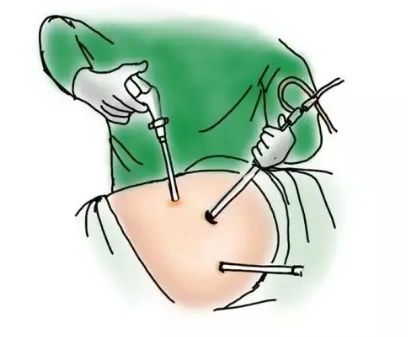 肝胆胰肿瘤微创手术治疗专家徐继威:腹腔镜微创率超80%,更美观更微创