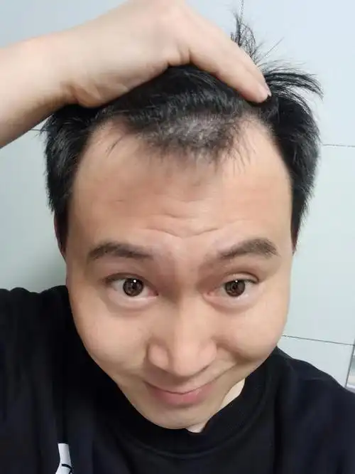 终有一天我会告别,我的秃鬓角,那时我已谢宝坤