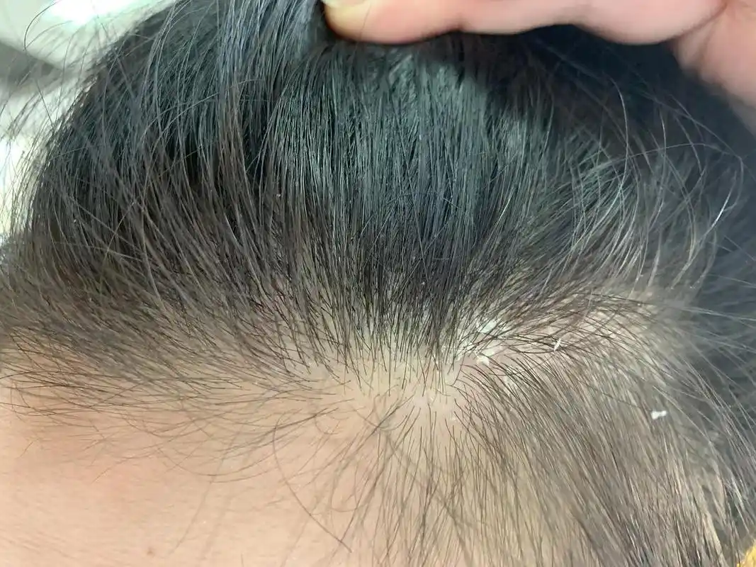 omg这么大块的头皮屑吓死我