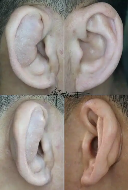 典型病例:耳廓假性囊肿_耳廓假囊肿_介绍_治疗方式 - 好大夫在线