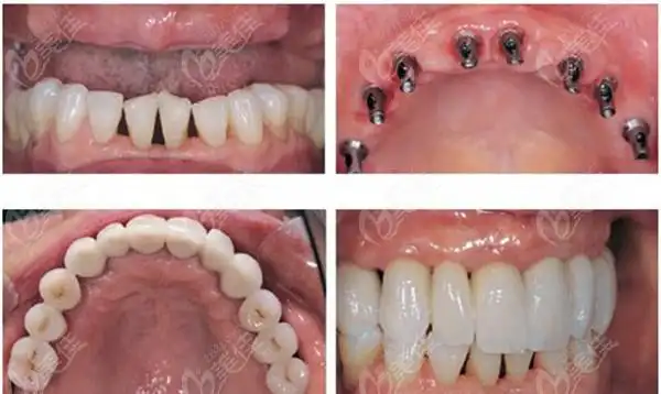 沈阳欢乐口腔种植牙前后效果图