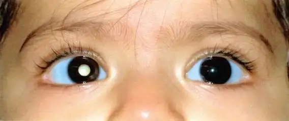 宝宝瞳孔发白要当心 - 好大夫在线