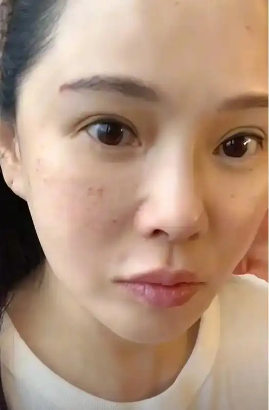 秦昊老婆跑韩国打水光针,56岁伊能静满脸针眼,感慨:真的很痛