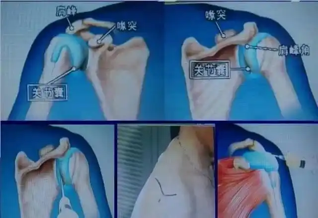 关节穿刺各关节腔穿刺方法技巧大全