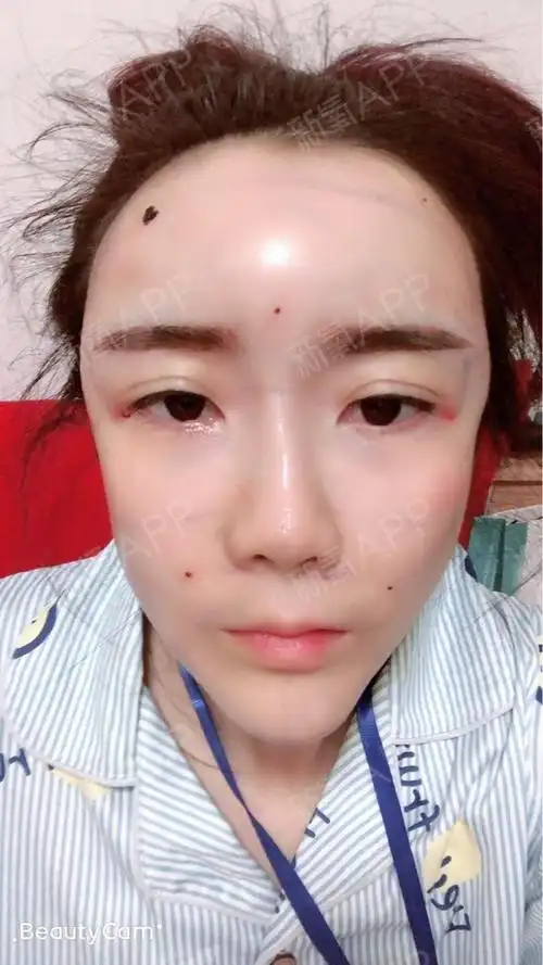 自体脂肪填充全脸