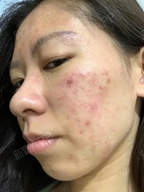 果酸换肤第四次的第二天脸干结痂了疼难看.