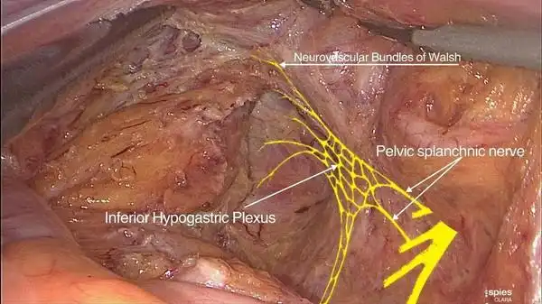 横行结肠成形术是在拟行吻合的结肠末端纵行切开4~   cm,并将其合向