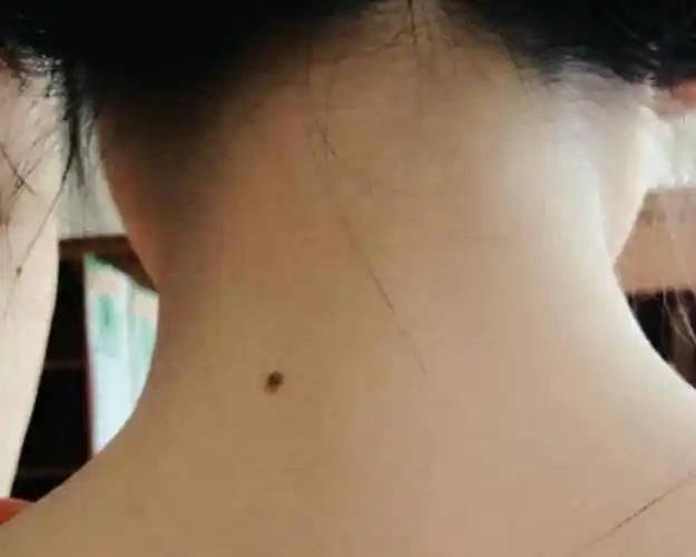 为啥有的人脖子后边有一颗"痣"?是好是坏?原来不是巧合