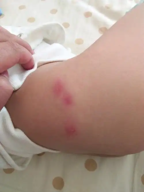 今天又发了红疹,都是三个连一起的,是牛奶蛋白过敏还是蚊虫叮咬