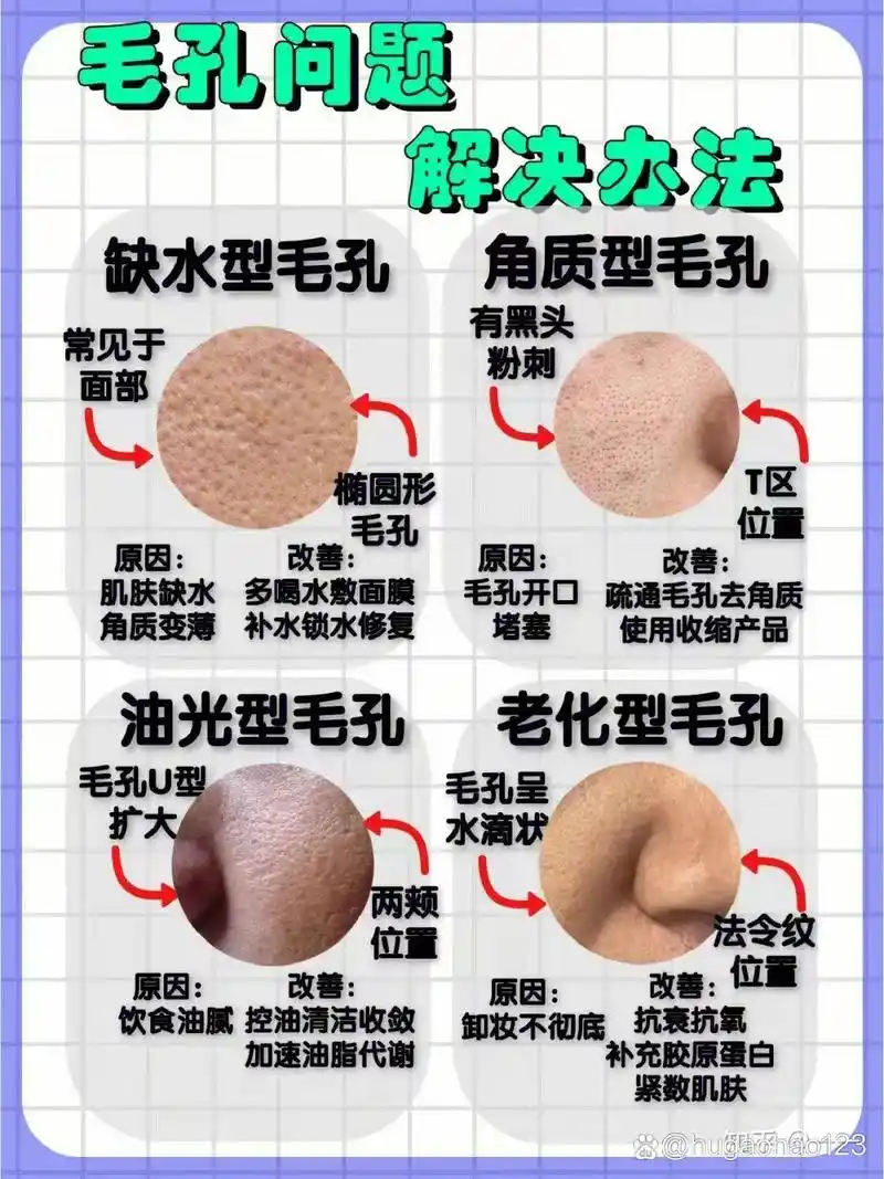 额头毛孔粗大有黑头怎么处理