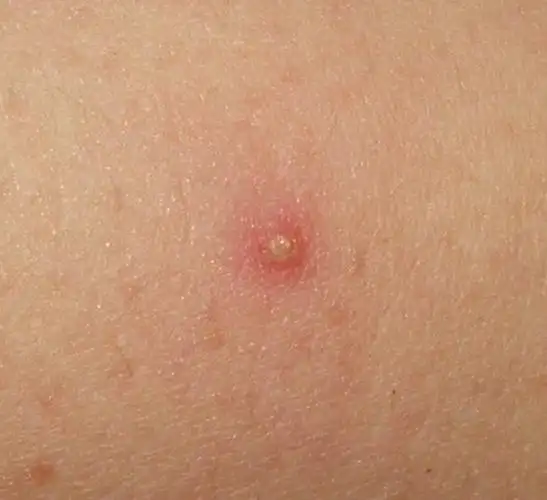 毛囊炎形成的脓包质地较硬,会产生轻微的疼痛或瘙痒感,脓疱溃破后会