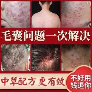 治疗头皮毛囊炎专用头部脖子前胸后背私处马拉色菌痘痘中药酊膏药