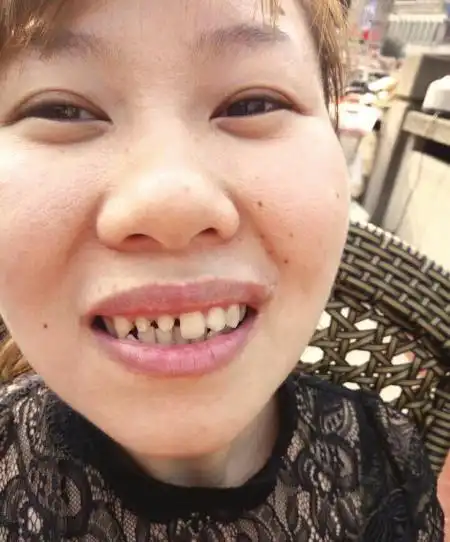 女子摔断牙齿去就医 被医生磨掉好牙