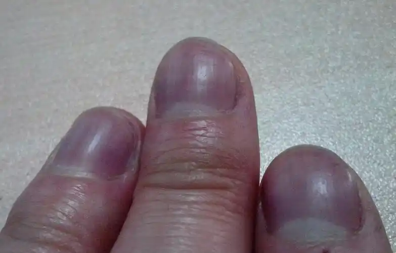 最近一周发现手指甲发紫,不是受冷了,请问会是什么原因呢?