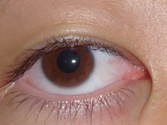 孕妇老人儿童眼睛里面有红血丝分别是怎么回事