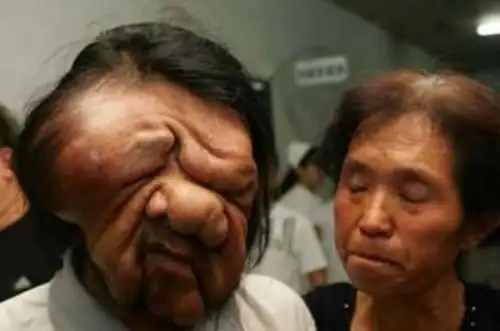 世界上长得最恐怖的人:湖南象人黄春才脸上15公斤神经纤维瘤 - 吐客网