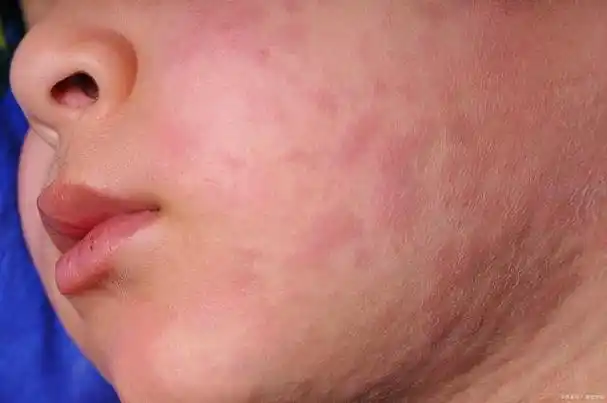 宝宝脸部红痒是怎么回事?