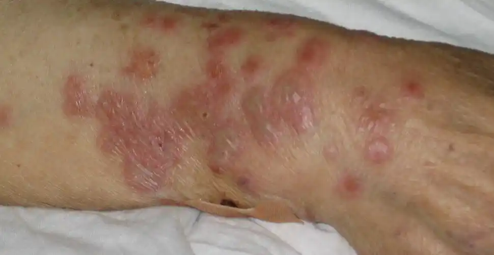 住院期间出现以双上肢为重的多发疱疹,持续一周开始消退,体温恢复正常