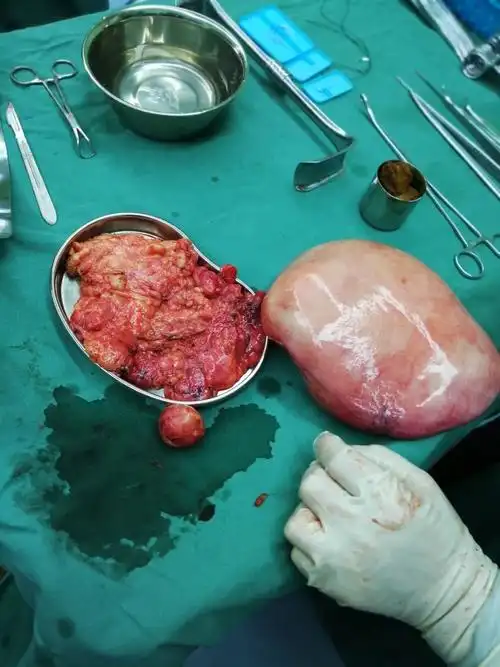 手术所取全部肿瘤