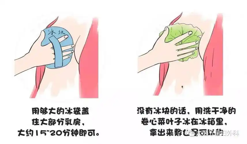 产后生理性乳胀太痛苦怎样避免和解决soeasy