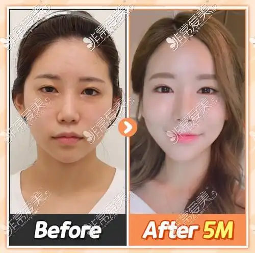 全脸脂肪填充对比