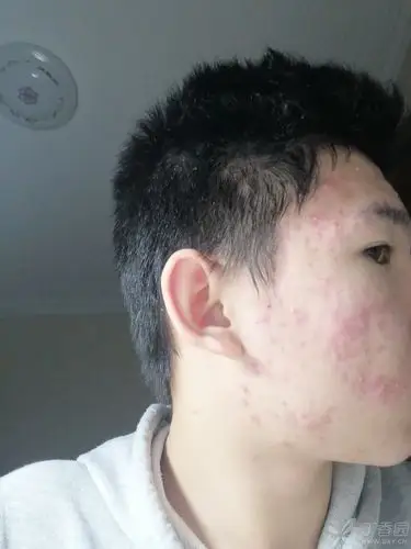 怎么治疗痤疮 - 皮肤与性传播疾病讨论版 -丁香园论坛
