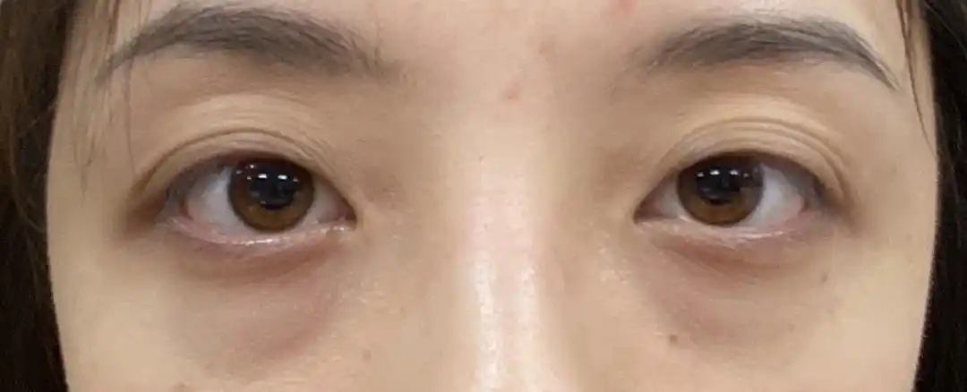 黑眼圈眼袋多层眼皮怎么办啊呜呜呜