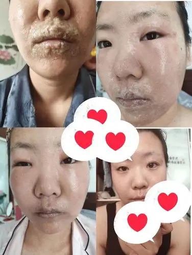 皮肤过度水合有什么危害?