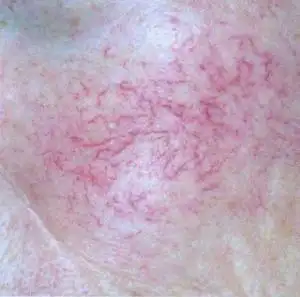 鼻子上有红血丝 鼻子上有红血丝激光治疗后多久能看不出来