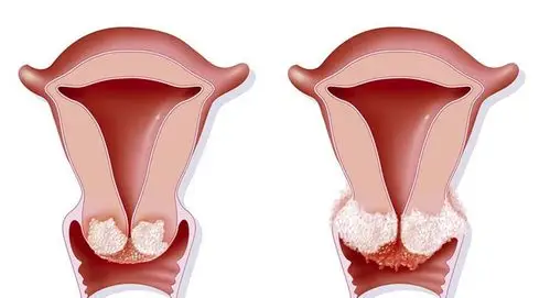 宫颈癌图片 (32)