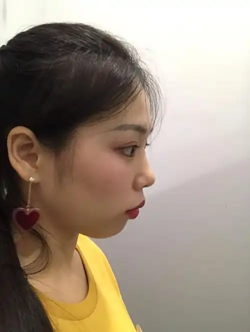 骨性龅牙矫正一年半啦,来组对比照