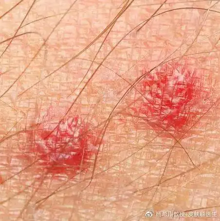 当私处"痘痘",撞上阴部毛囊炎
