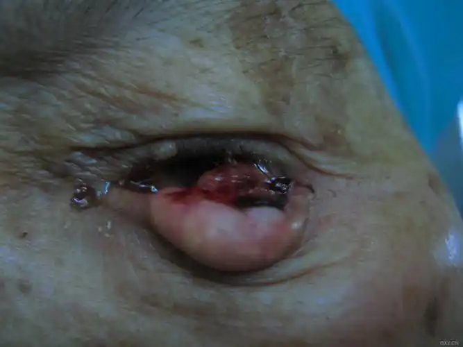 病历讨论 下眼睑肿物