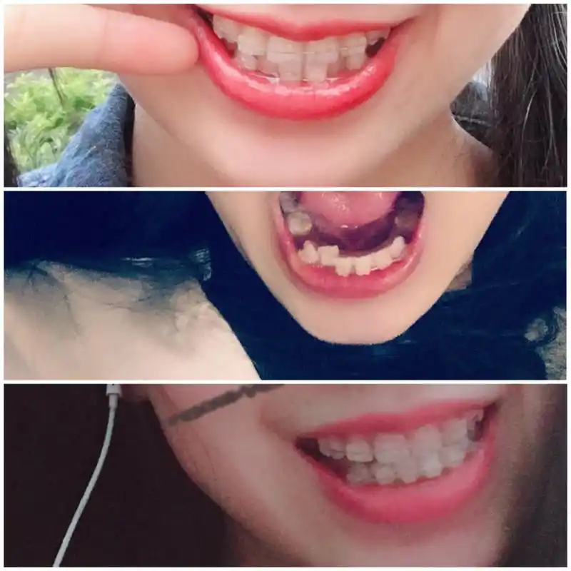 矫正牙齿/3个月变化#矫正牙齿 06戴牙套三个月 93凹凸的两颗牙齿