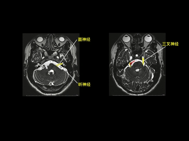 面神经,听神经,三叉神经颅脑 mri 矢状位垂体瘤颅脑 mri颅脑 mrv鞍上