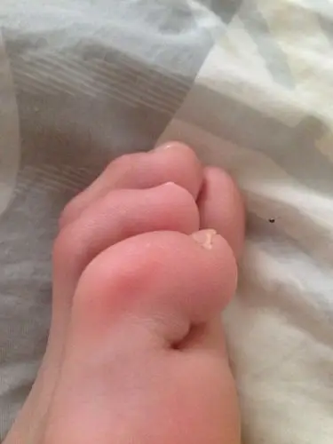 重小脚趾就开始弯了,但不影响走路那些,就样子不好看,需要动手术吗