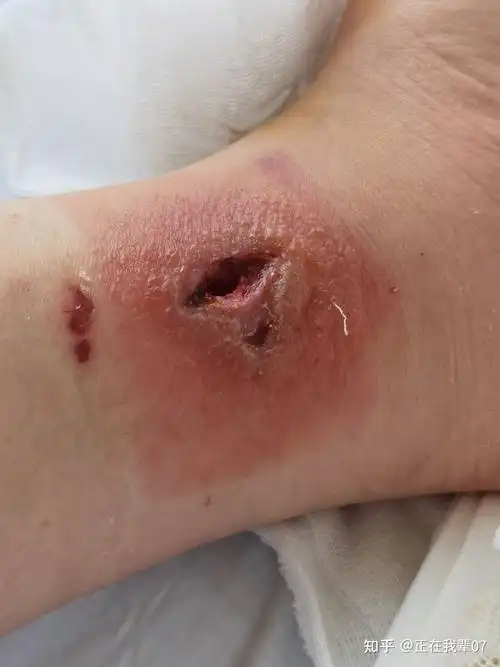 热水袋低温烫伤记录图片