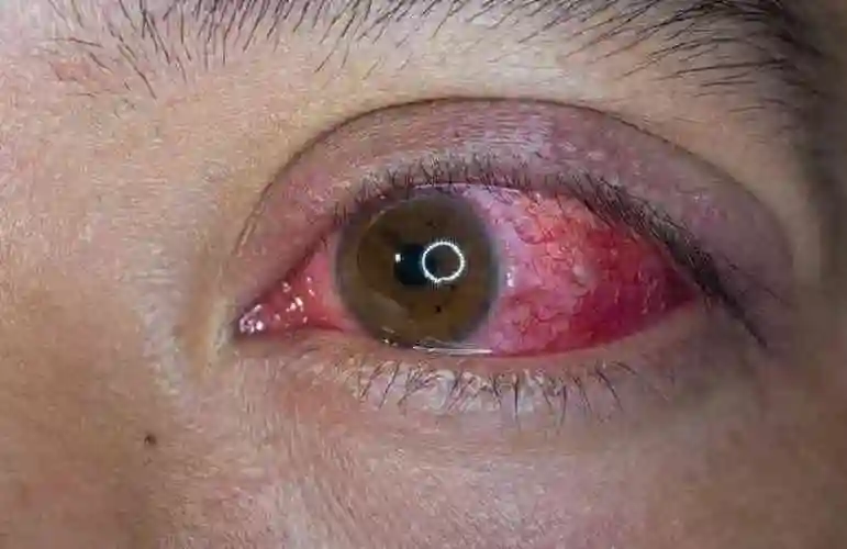 求医生解答宝宝眼角发红是怎么回事有什么危害吗