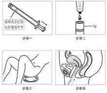 1,治疗宫颈糜烂:月经干净后第3天开始用药,隔日一次,一次1克,6-10次为